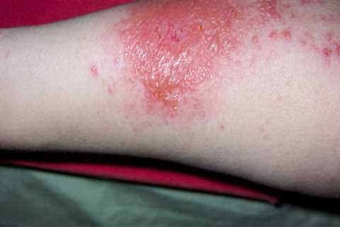 What's poison ivy rash look like?