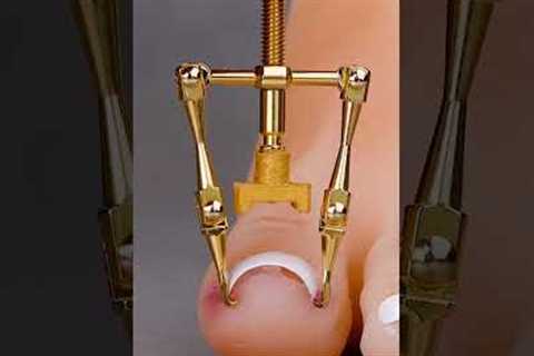 Ingrown toenail gadget hack #shorts